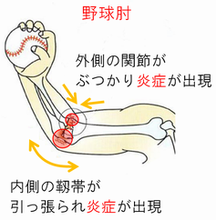 「野球肘」の画像検索結果